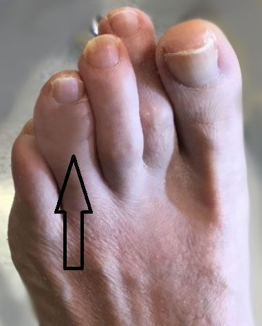 4-6 weeks after surgical correction