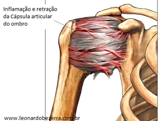 Fisioterapia para Capsulite Adesiva