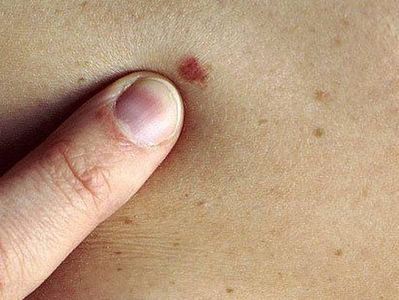 Piden a gomezpalatinos cuidarse para prevenir cáncer de piel