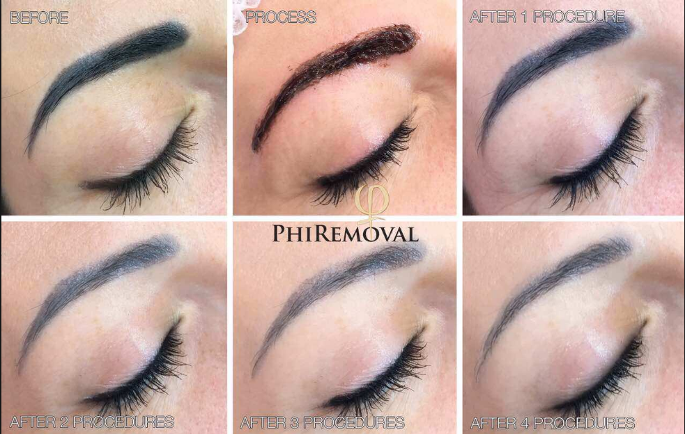 PhiRemoval Process