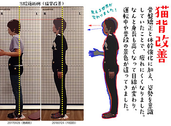 猫背改善ビフォアアフター