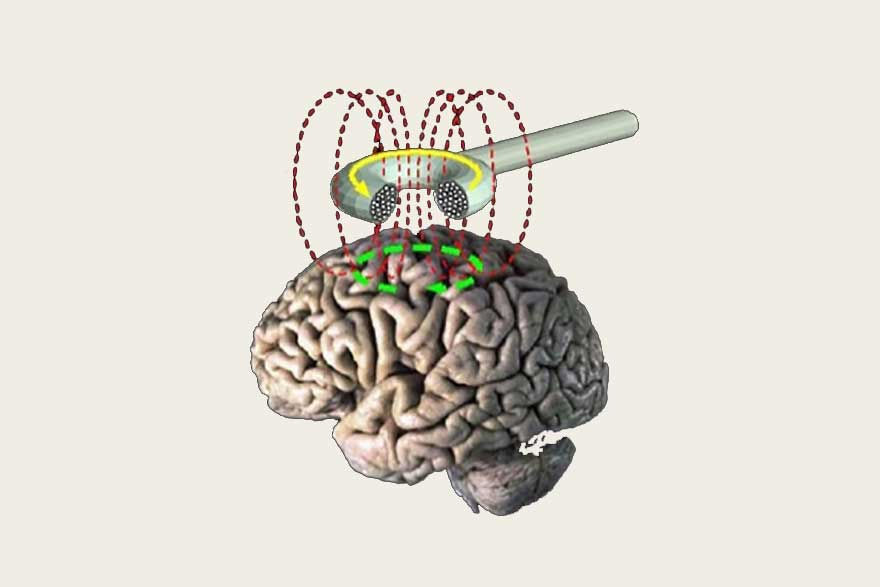 La estimulación magnética transcraneal, más efectiva para el tratamiento de la depresión resistente. Centro de Psicología Aplicada Maribel Gámez