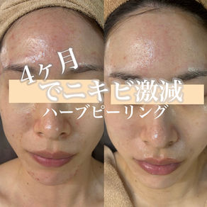 ハーブピーリング4ヶ月でこんなに変化!