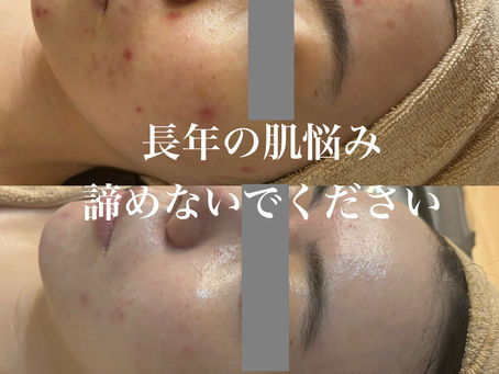 長年の肌悩みハーブピーリングにお任せ!