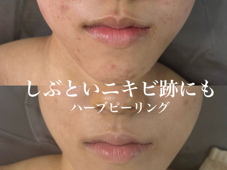 ニキビ跡にもハーブピーリング!