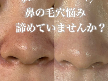 鼻の毛穴にもハーブピーリング！