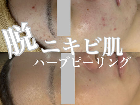 脱！ニキビ肌！