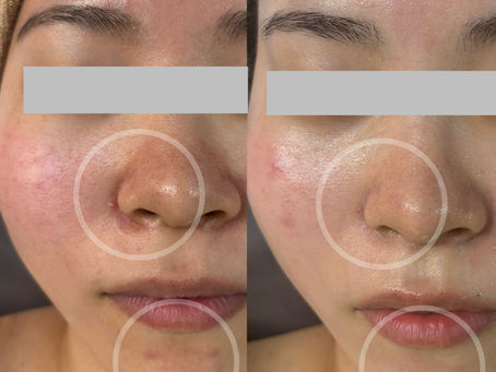 効果がすぐ分かるからこそ続けたくなる!ハーブピーリング!