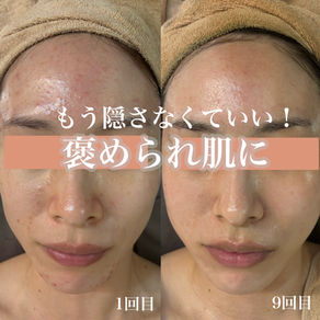 ハーブピーリングで褒められ肌に！