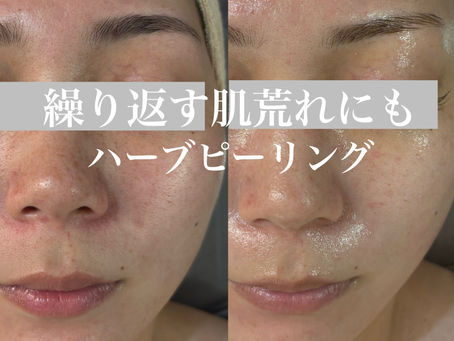 繰り返す肌荒れにもハーブピーリング!