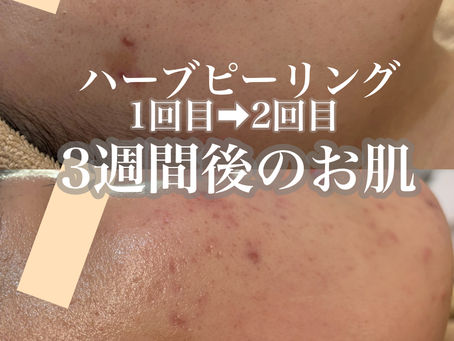 ハーブピーリング2回目でニキビ激減！