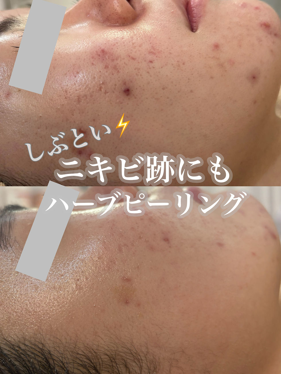 ニキビ跡にもハーブピーリング！