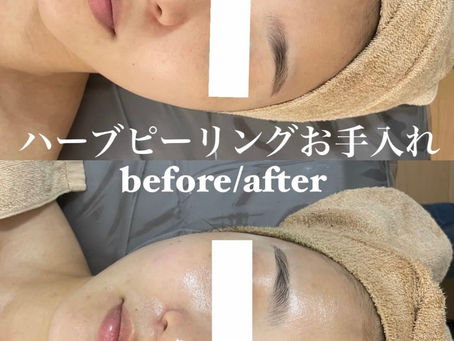 ハーブピーリングお手入れbefore/after