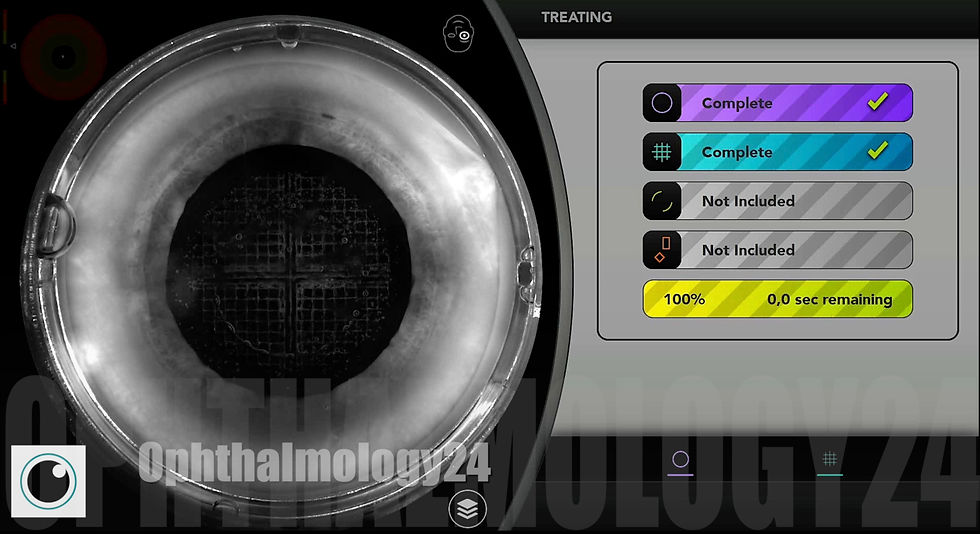 Femtosecond Laser-Assisted Cataract Surgery (FLACS)