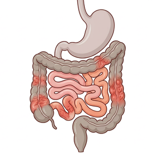 What is IBD