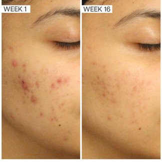 Face Reality Skincare Acne Program Before and After