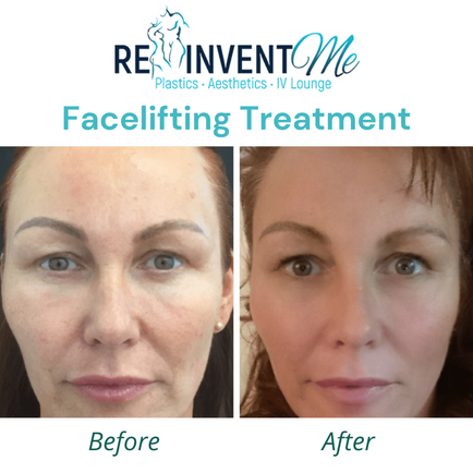 facelift before/after photo