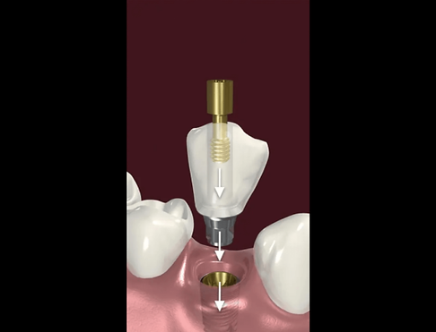 screw retained crown 3.png