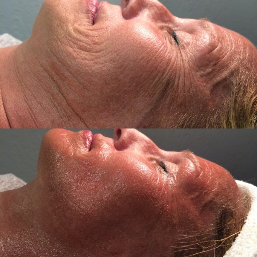 NeveSkin facial treatment before and after results