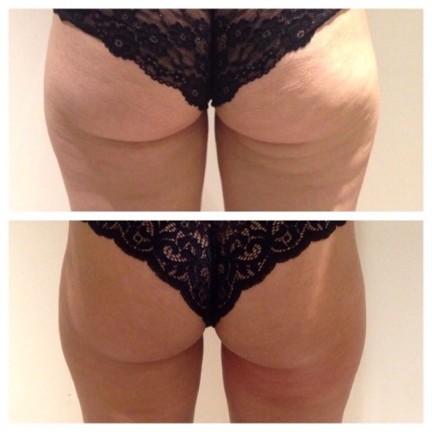 NeveSkin body toning before and after results