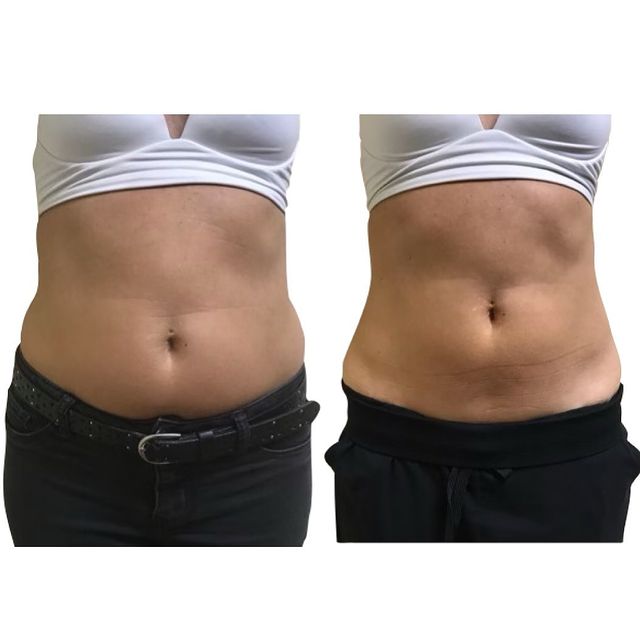 NeveSkin CryoSkin treatment