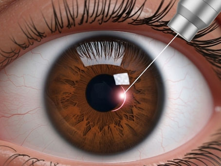 Cirurgia Refrativa: A Revolução dos Lasers que Transformou a Visão