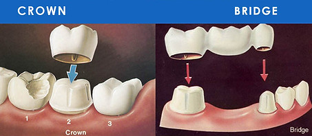 pVgdental-crowns-bridges.x43969.jpg