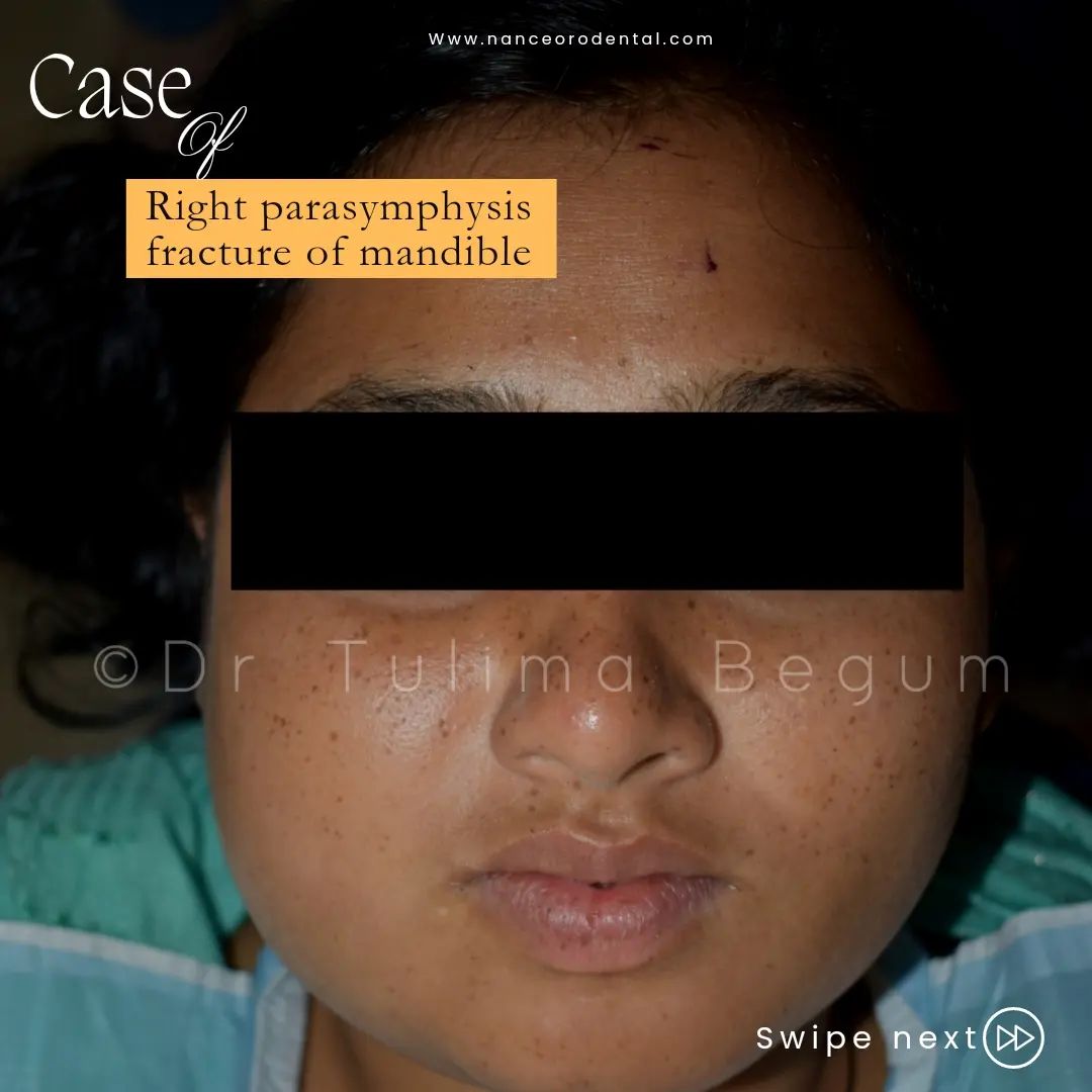 Parasymphysis fracture of mandible