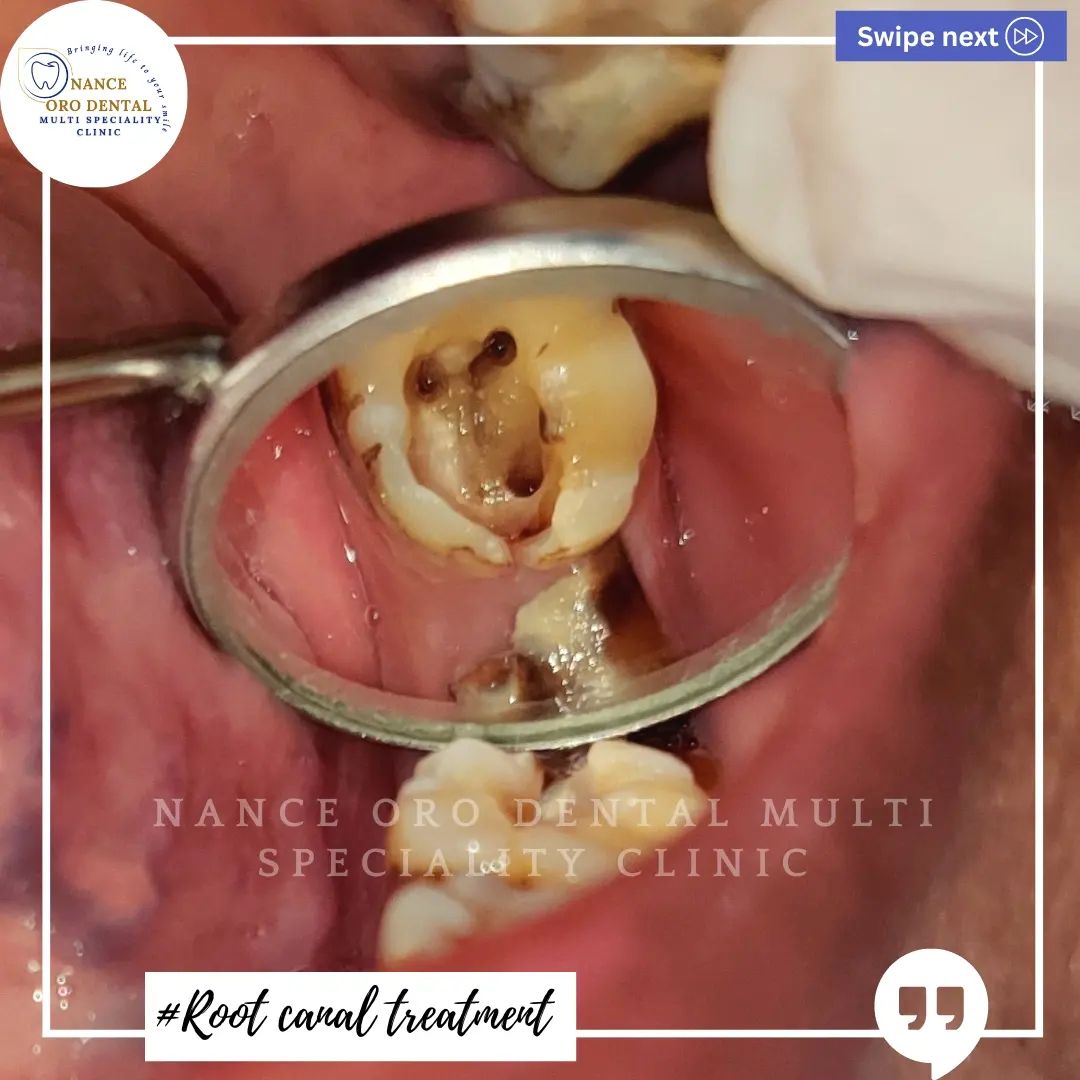 Root canal treatment