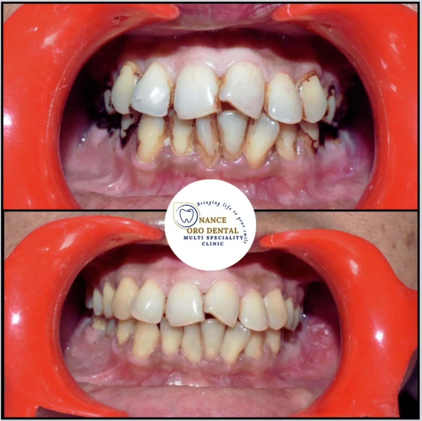 Oral prophylaxis