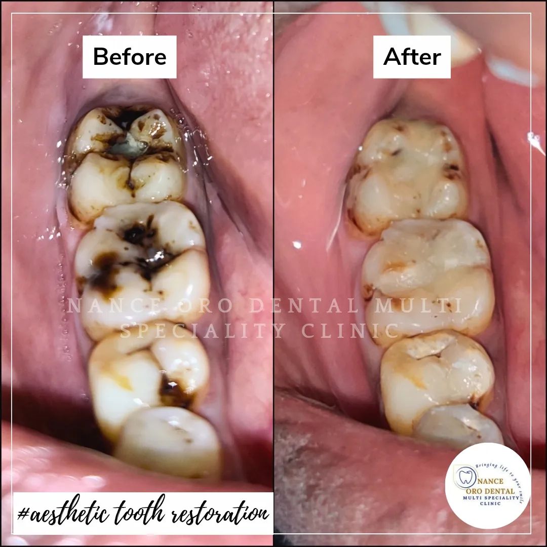 Aesthetic tooth restoration
