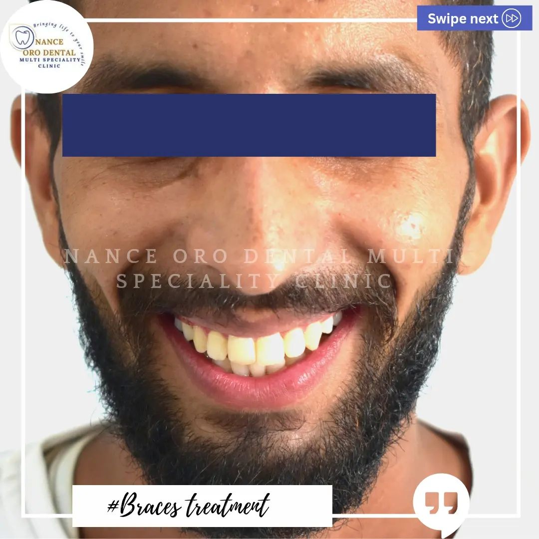 Braces treatment