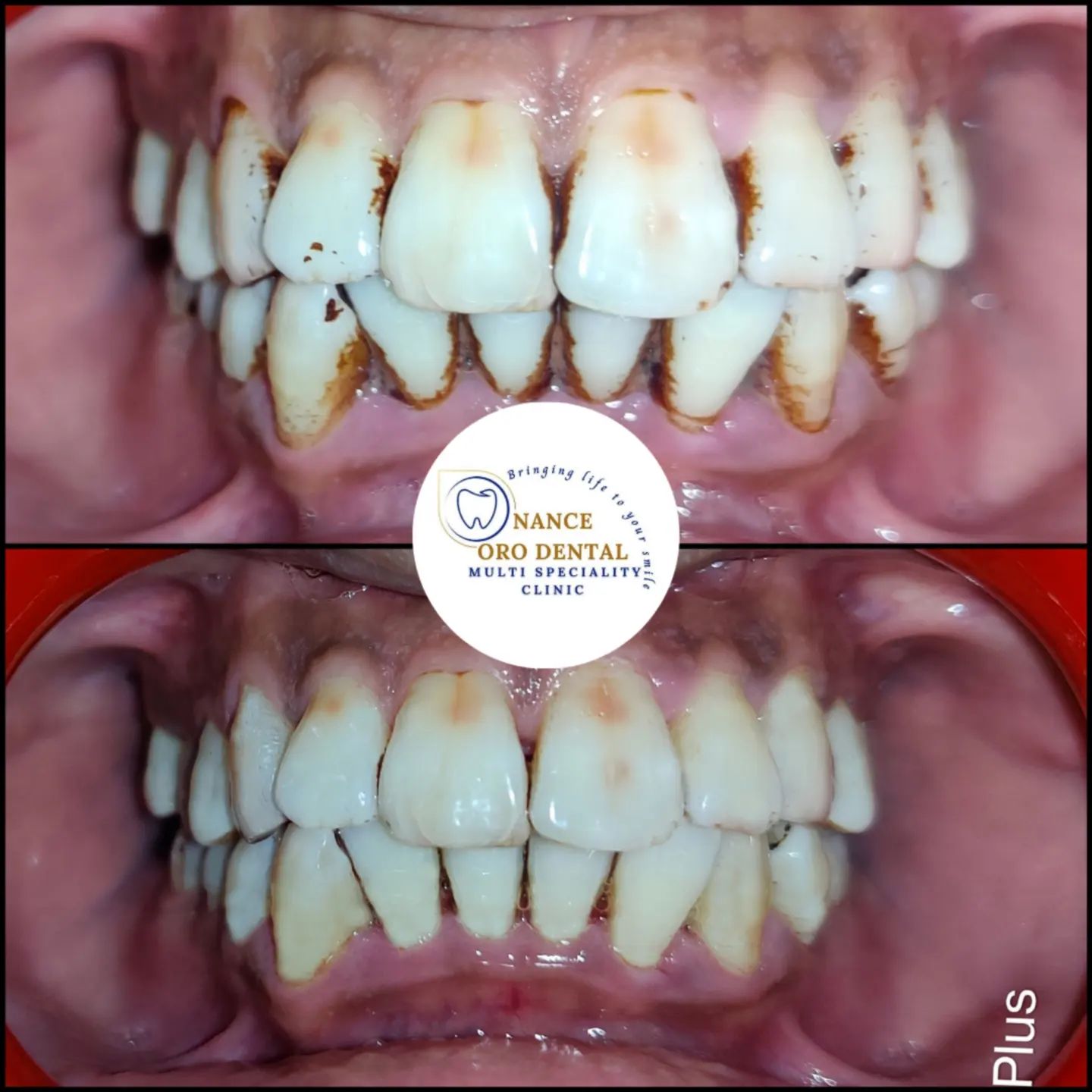 Oral prophylaxis