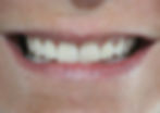 Sourire avant le service de blanchiment dentaire