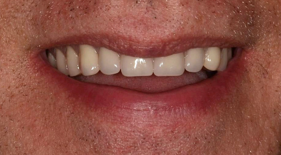 sourire après traitement de prothèses amovibles