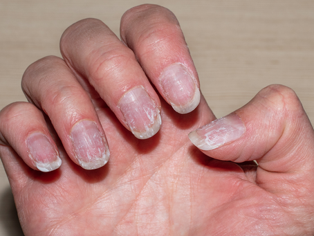 manos femeninas con uñas naturales cortas resecas y maltratadas