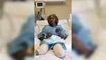 Minnesota Woman Loses Both Hands and Both Legs After Receiving Second Pfizer Covid-19 Vaccine