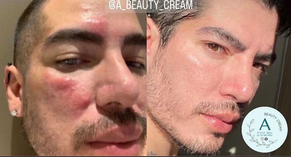 Miniatura: CREMA P/ ACNE ARACELI TAPIA 