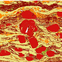 Garnet porphyroblasts in a sillimanite schist
