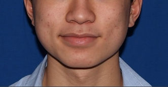 Hydrafacial 1_edited.jpg