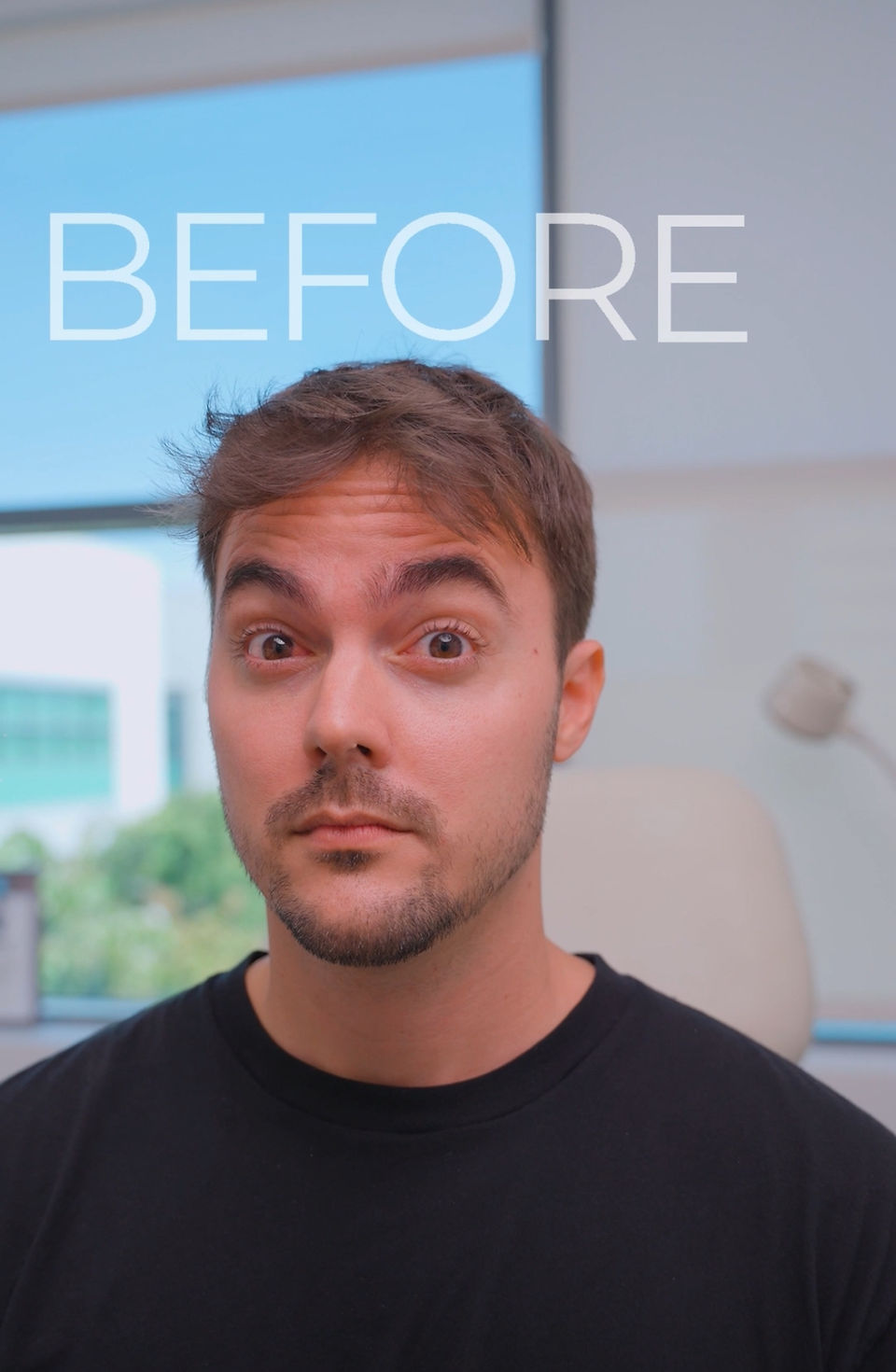 Male Botox