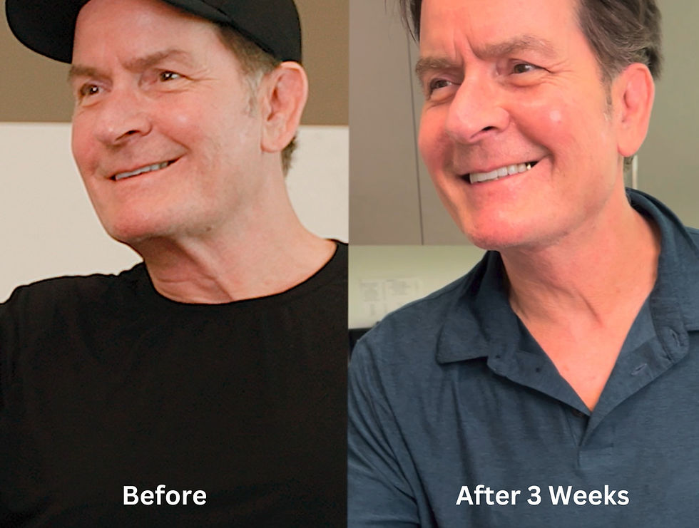 SurgYlift Charlie Sheen