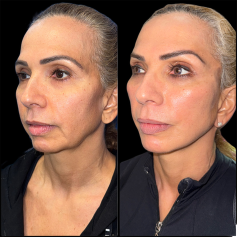 What Is the Best Age for a Facelift?