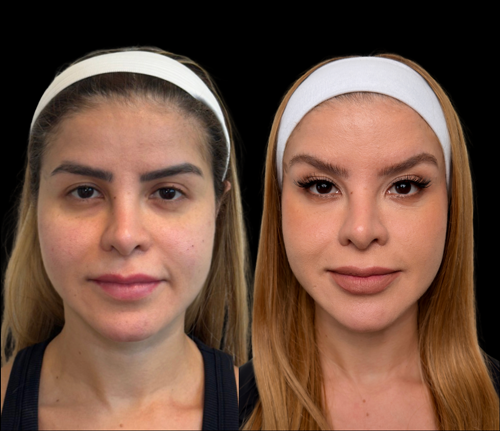 Scarless Facelift by Dr. G: The Future of Facial Rejuvenation