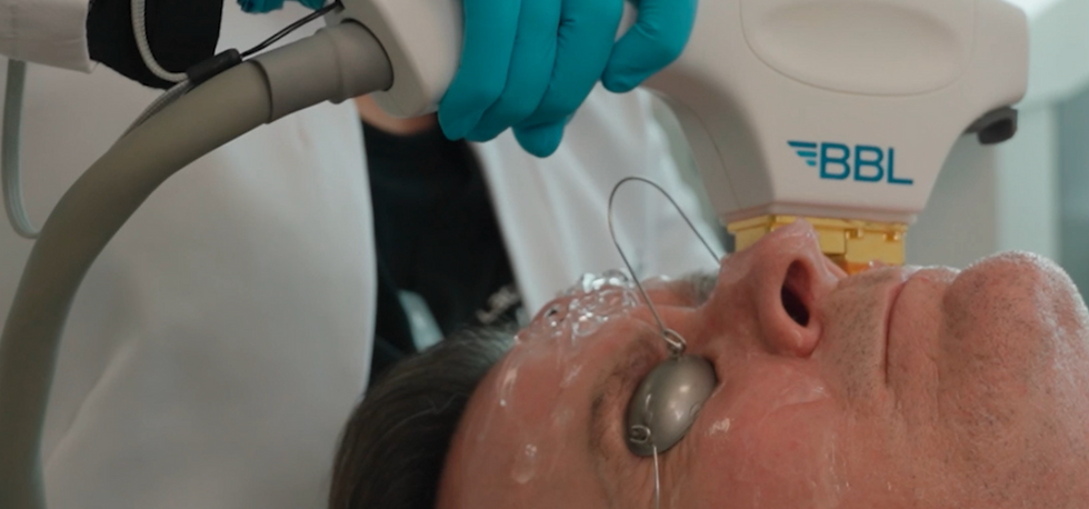 BBL LASER TREATMENT FOR MEN