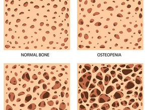 Osteoporosis: The Silent Bone Thinner