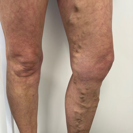 Why Do My Legs Hurt When I Walk? 
