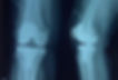 TKR (Total Knee Replacement)