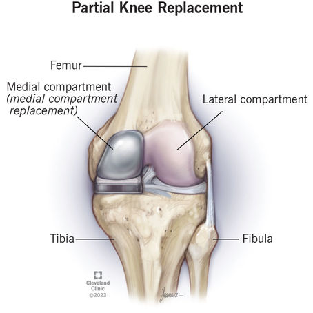 Partial vs Total Knee Replacement