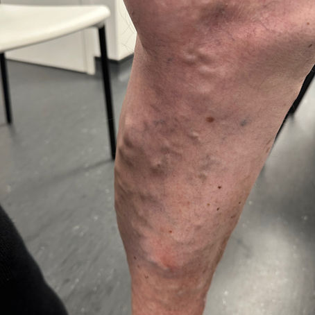 Varicose Veins